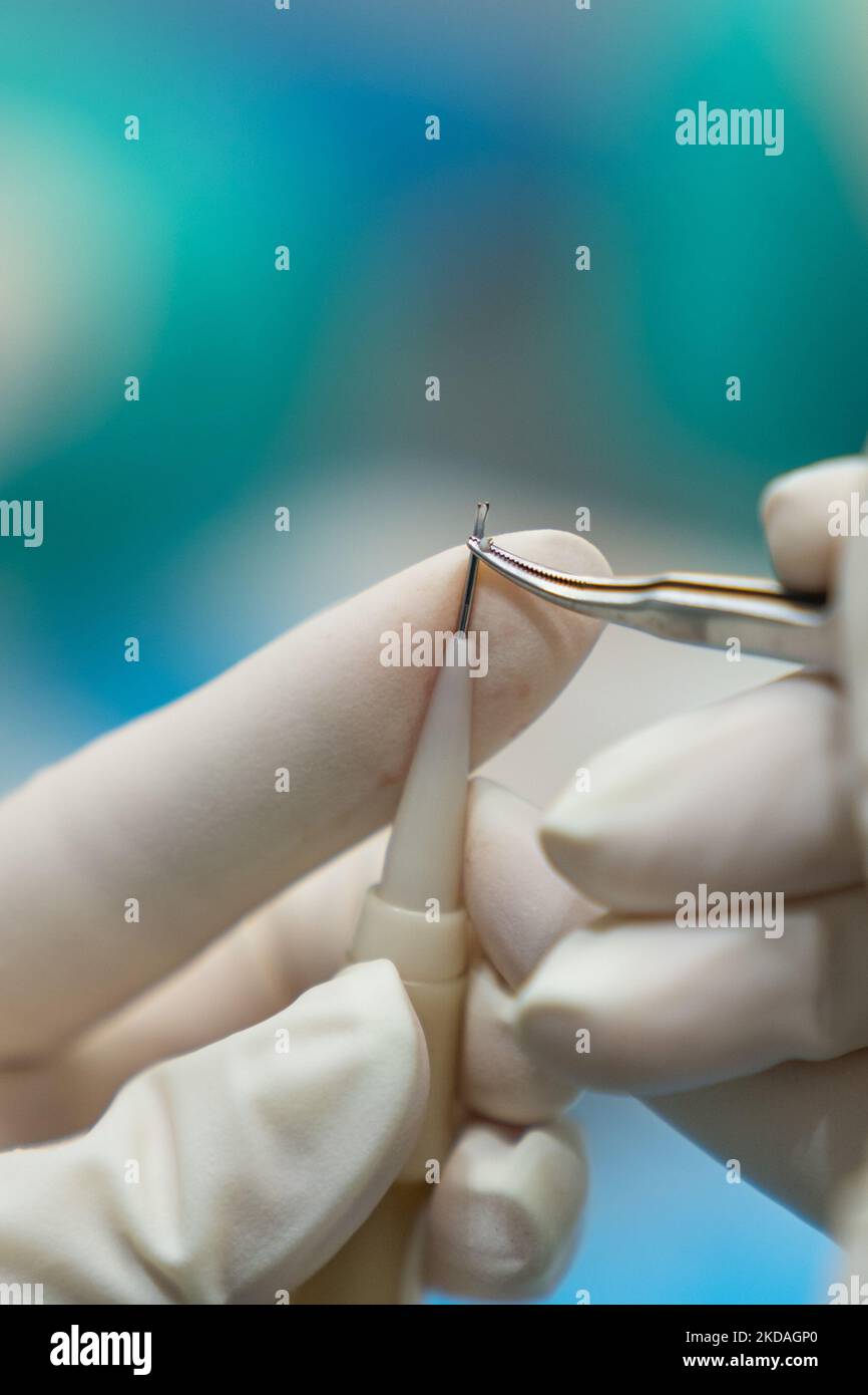 Close up of surgeon's hand placing a follicular unit in the implanter needle for hair transplantation. Stock Photo