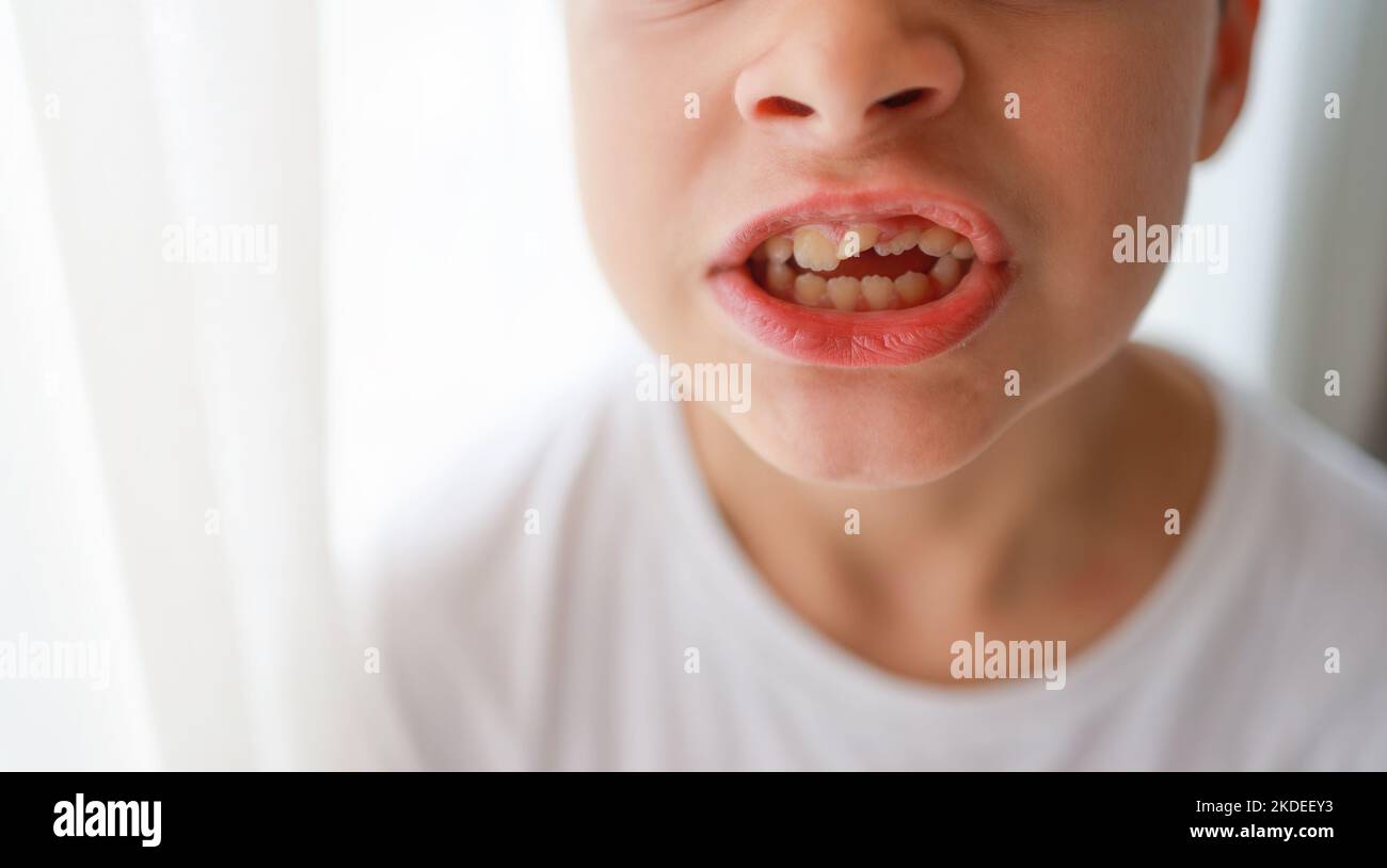 Ostrich With Human Teeth And Braces