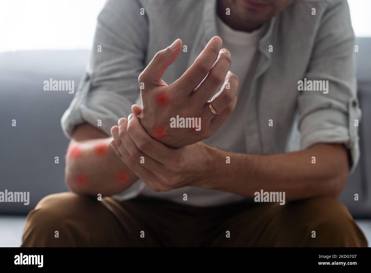 ill allergic rash dermatitis eczema skin of patient Stock Photo - Alamy