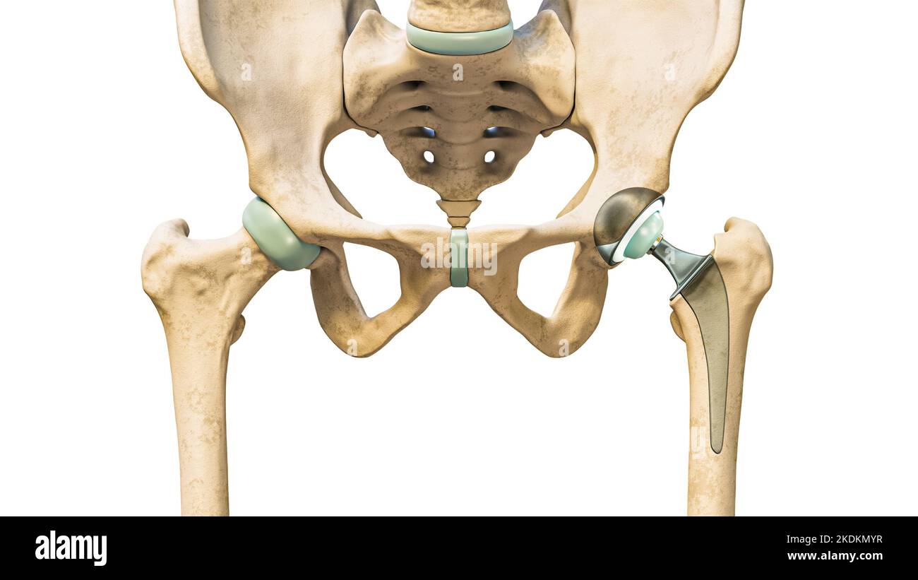 Hip prosthesis or implant isolated on white background. Hip joint or femoral head replacement 3D rendering illustration. Medicine, medical and healthc Stock Photo