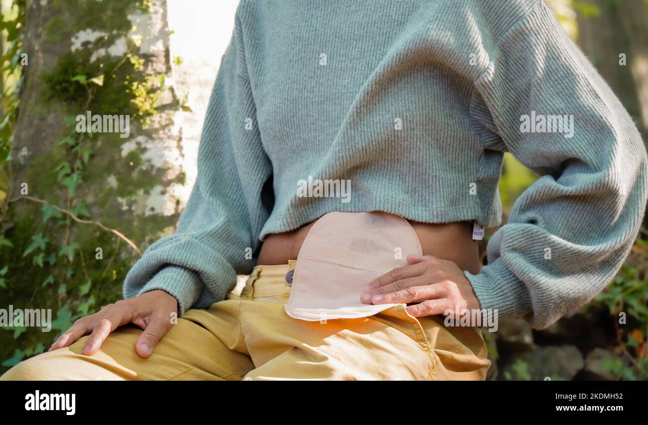 Ostomized person with a ostomy in belly in a beech forest Stock Photo