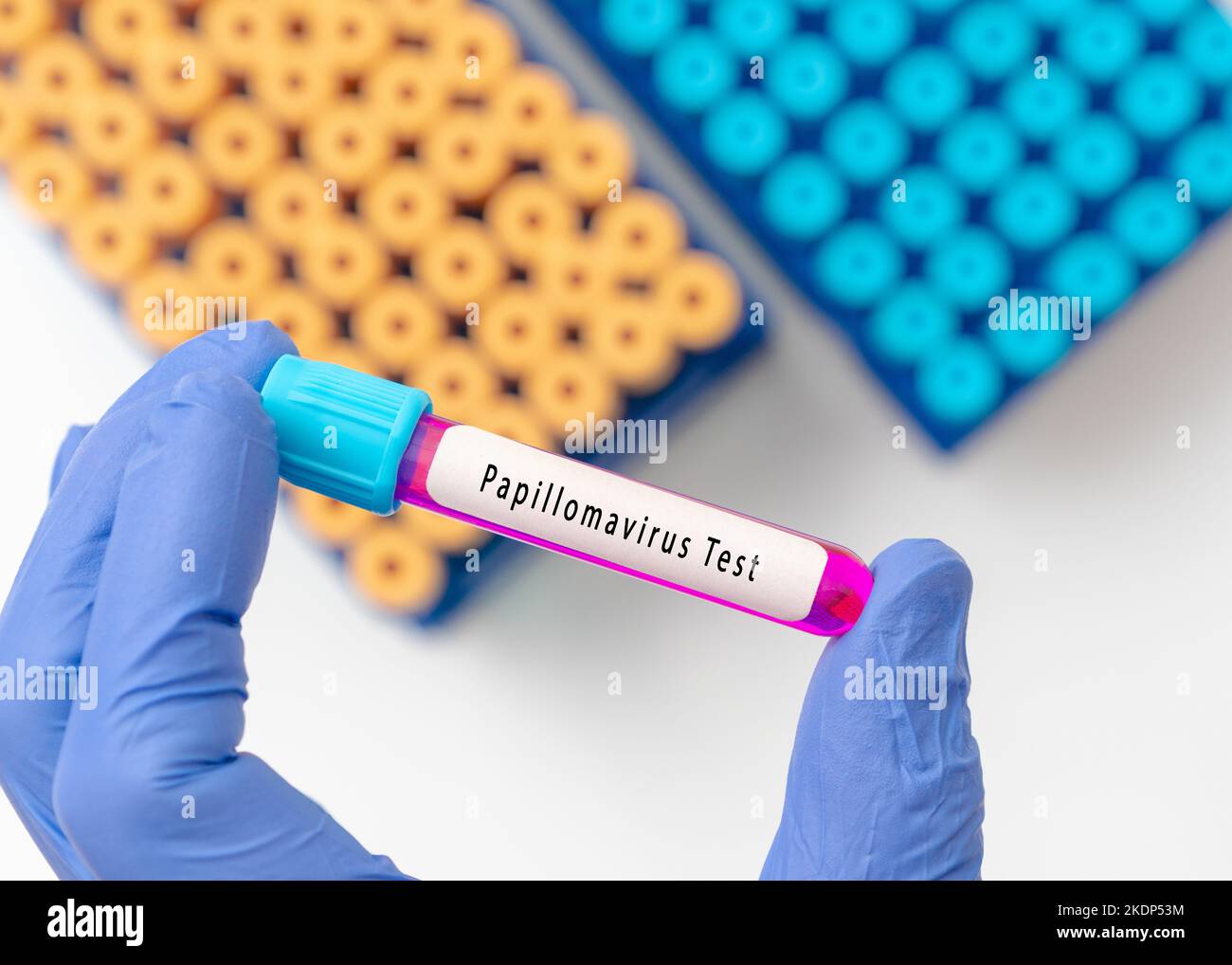 Papillomavirus test result with blood sample in test tube on doctor ...