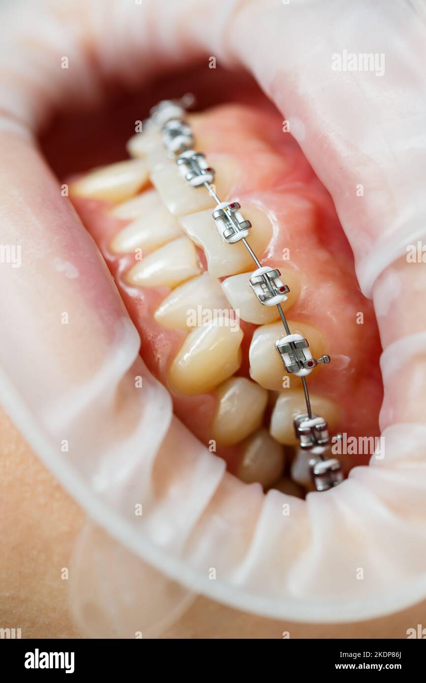 Installation of braces on teeth. Orthodontic dental treatment. Close-up ...