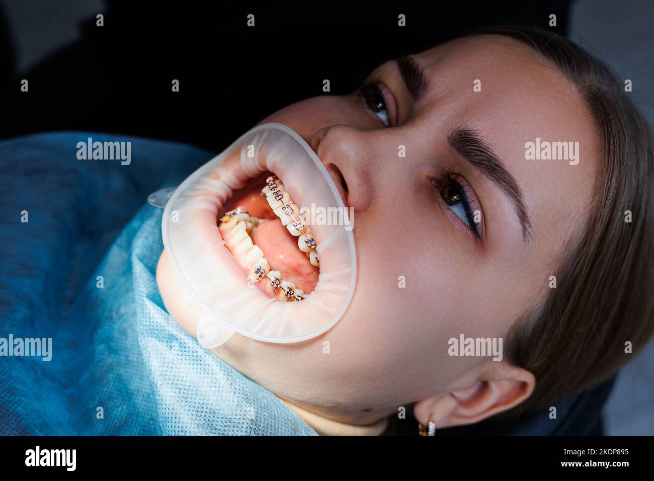 Extender for teeth. Teeth of a woman with braces at a dentist