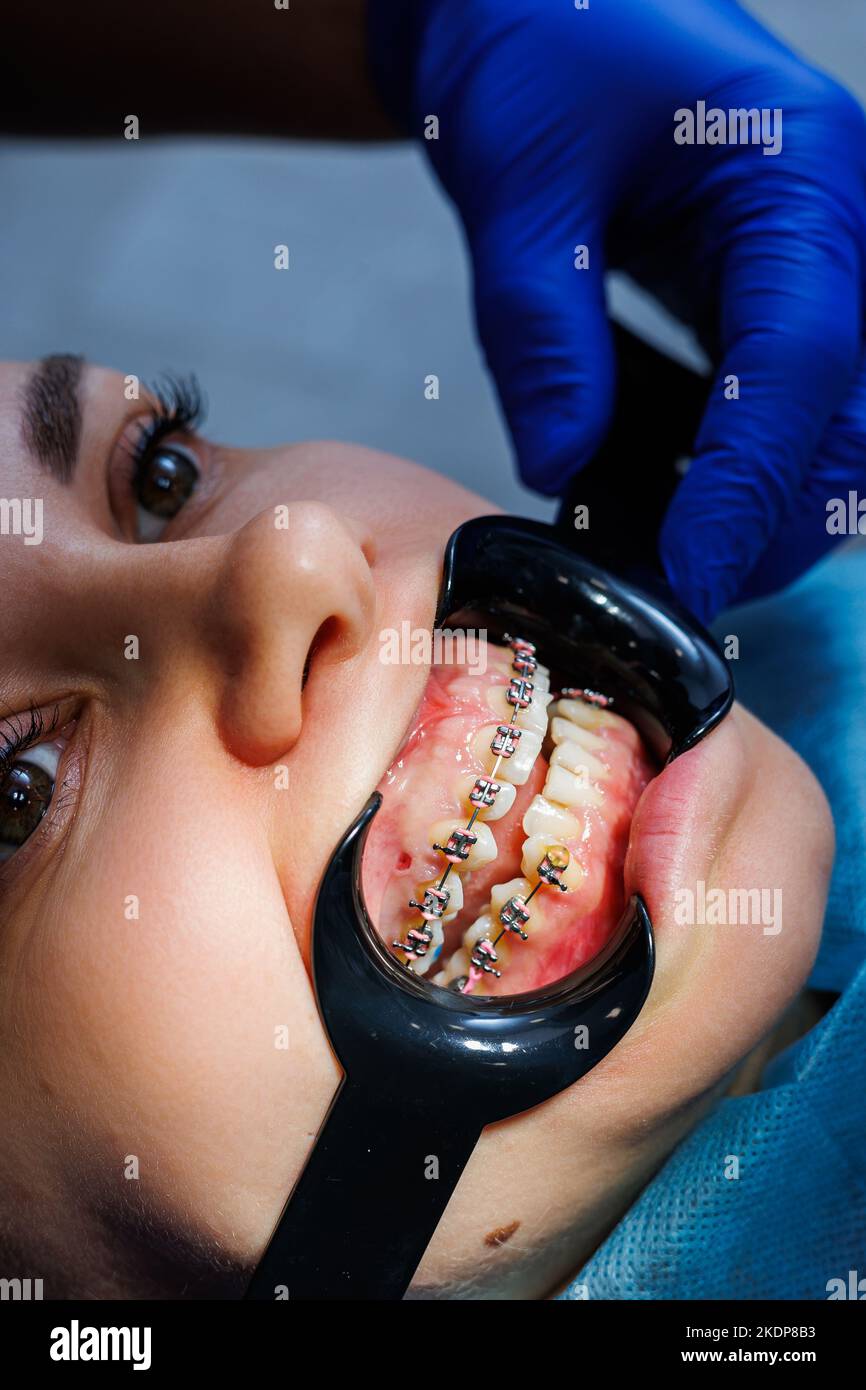 Extender for teeth. Teeth of a woman with braces at a dentist