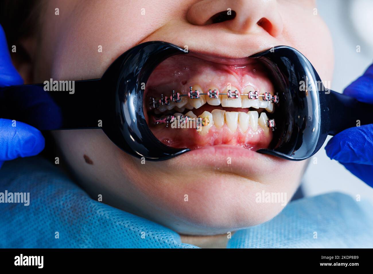 Extender for teeth. Teeth of a woman with braces at a dentist