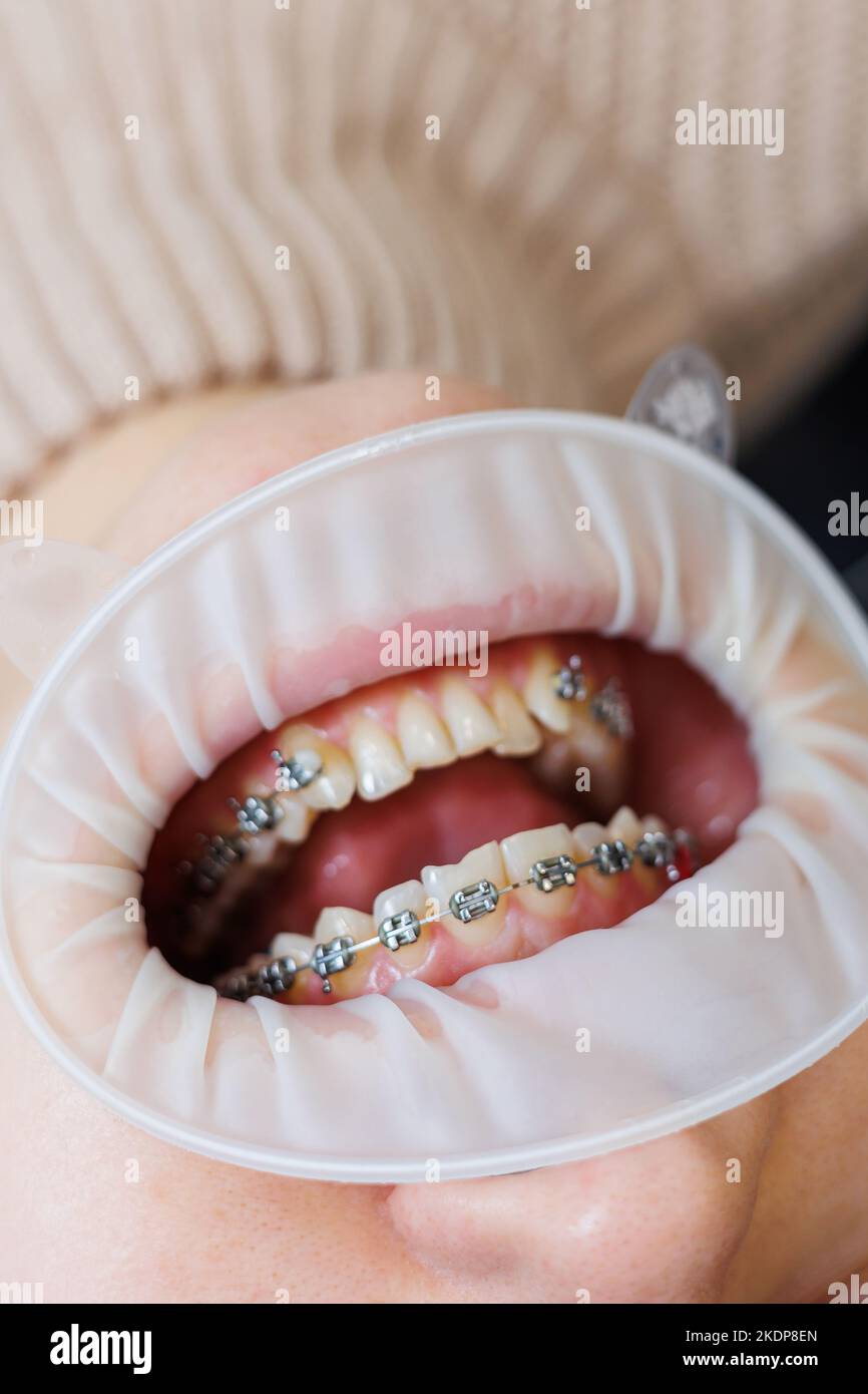 Teen girl with braces closeup hi-res stock photography and images - Alamy