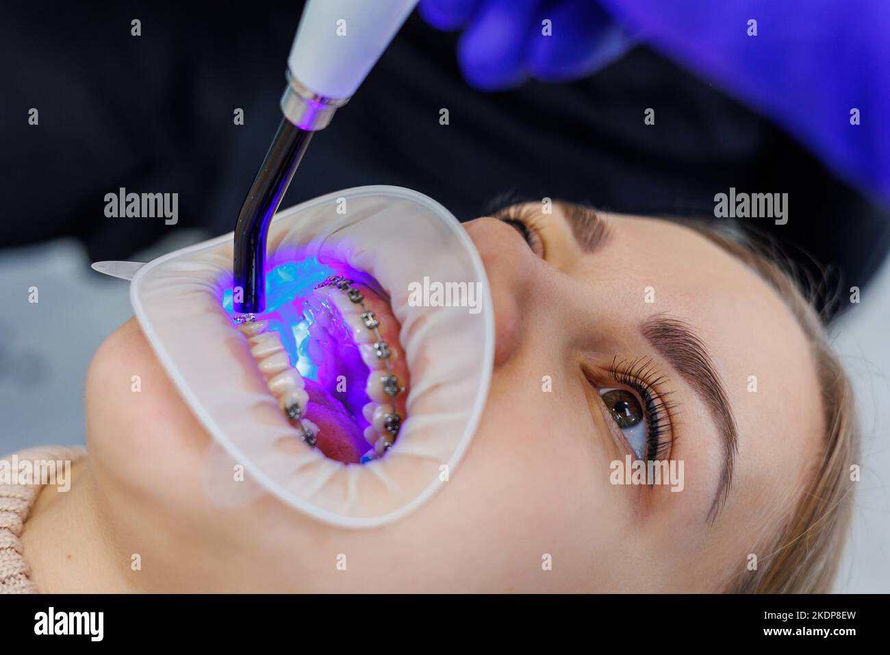 A woman's teeth with metal braces are being treated at the clinic. An ...