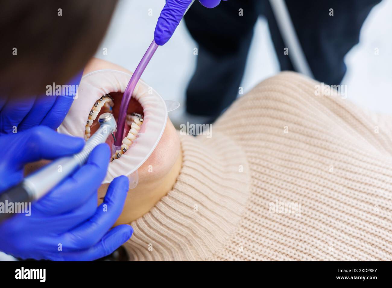 A woman's teeth with metal braces are being treated at the clinic. An ...
