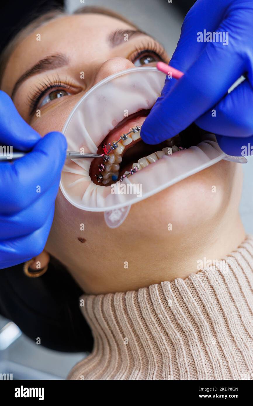 Woman teeth with braces on white teeth. An orthodontist uses dental