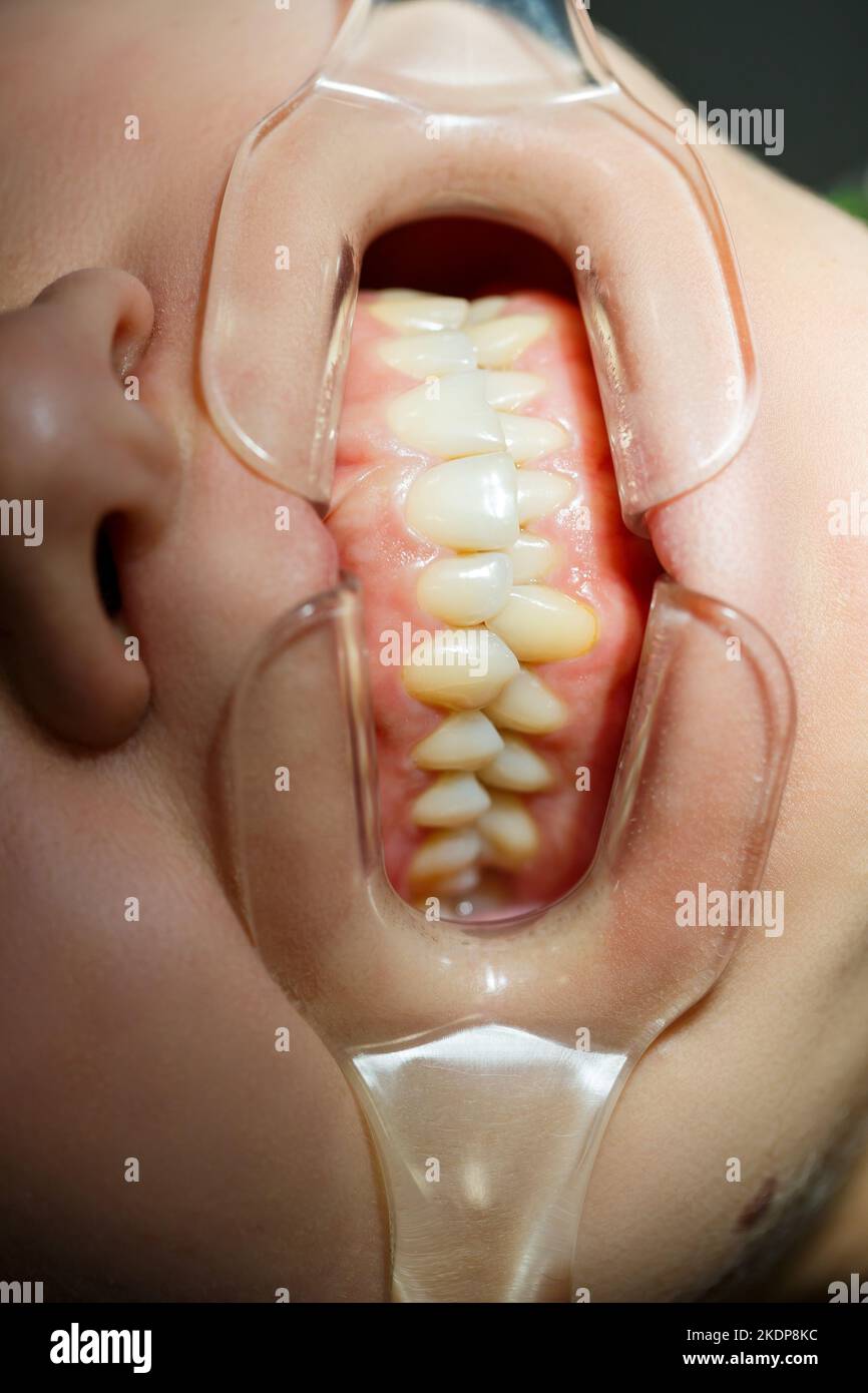 Close-up teeth, dental treatment at the dentist. Oral cavity care Stock ...