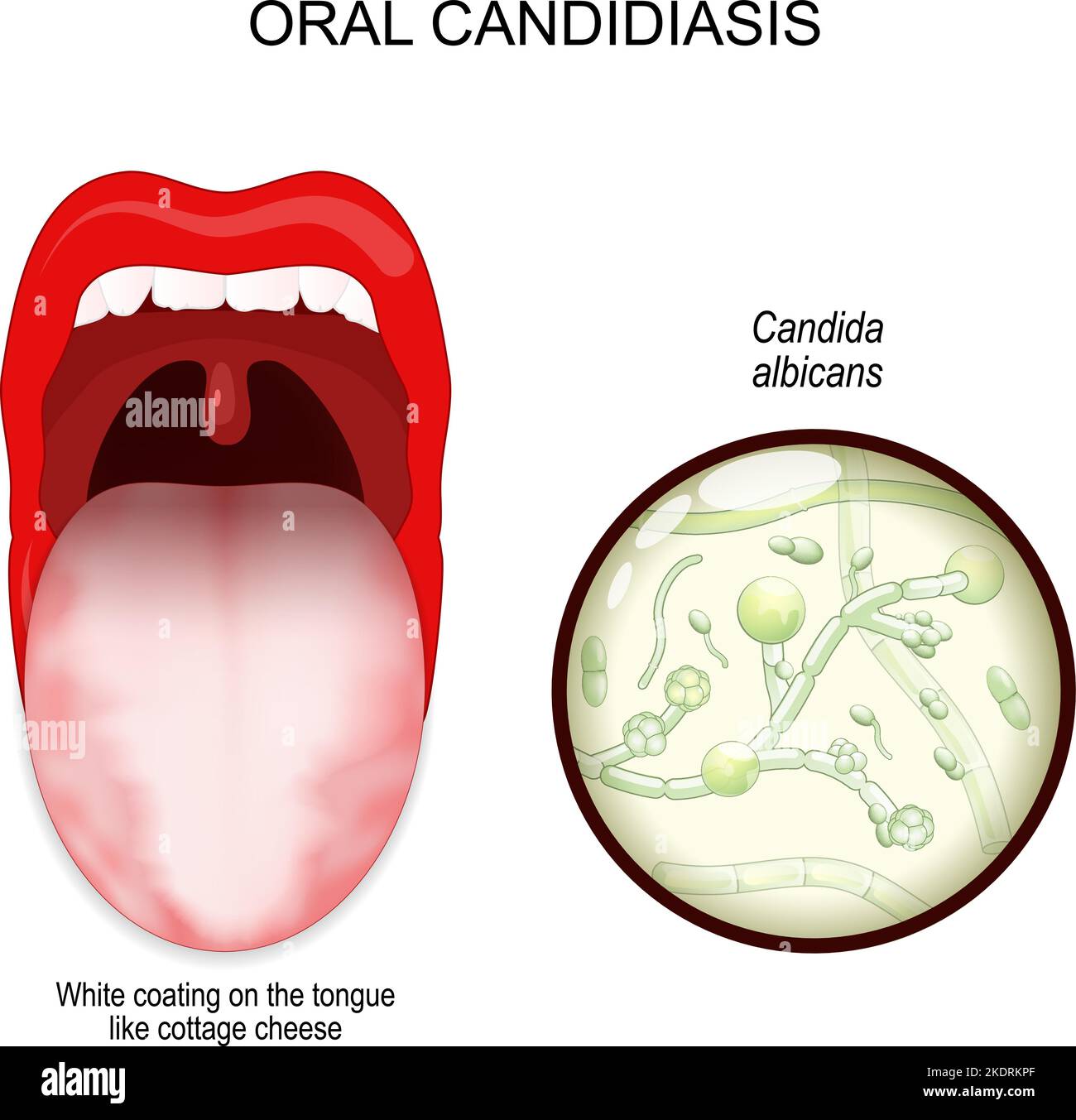 oral candidiasis. oral thrush yeast infection. White coating on the tongue like cottage cheese. Close-up of a fungi Candida albicans. Vector Stock Vector