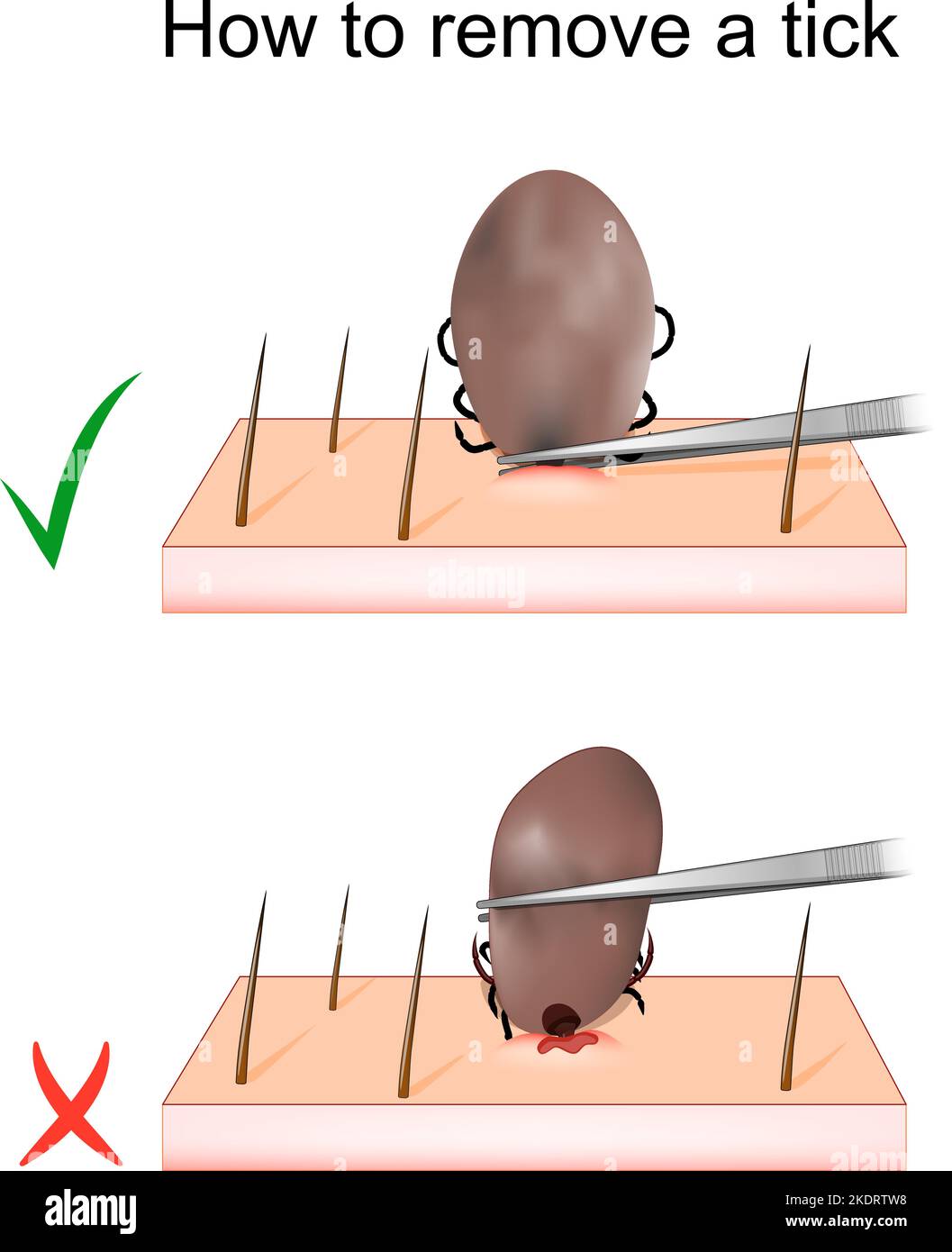How to remove a tick. mite Removal. Vector illustration Stock Vector