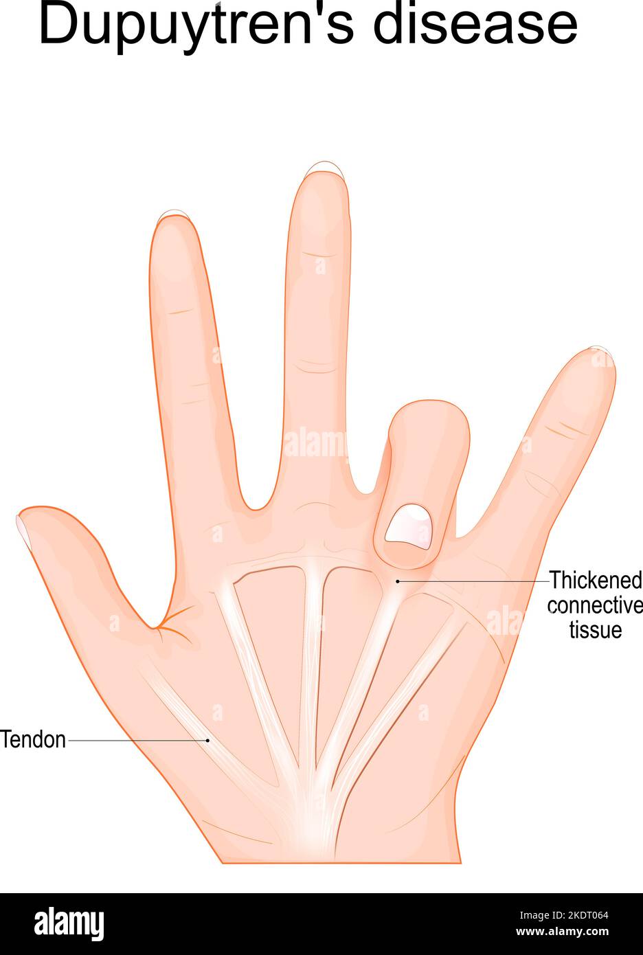 Dupuytren's disease. Human hand with Tendons and Thickened connective tissue under one finger. Vector illustration Stock Vector