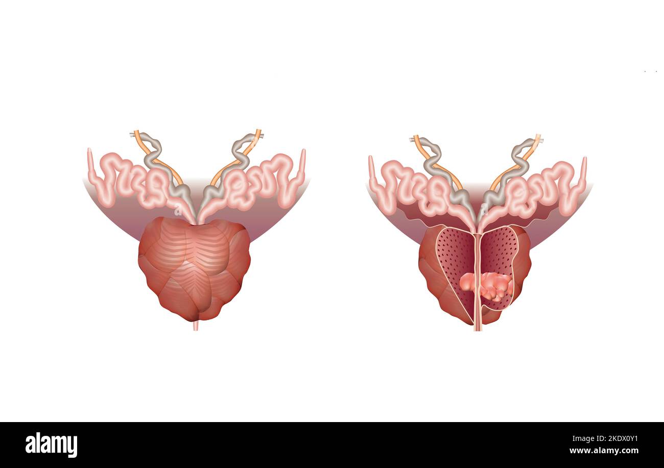 Prostate Cancer Backround Prostate cancer, illustration Stock Photo - Alamy