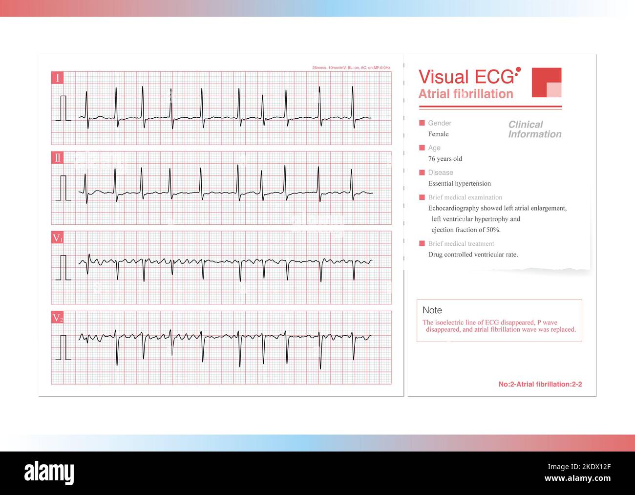 Atrial fibrillation, illustration Stock Photo - Alamy