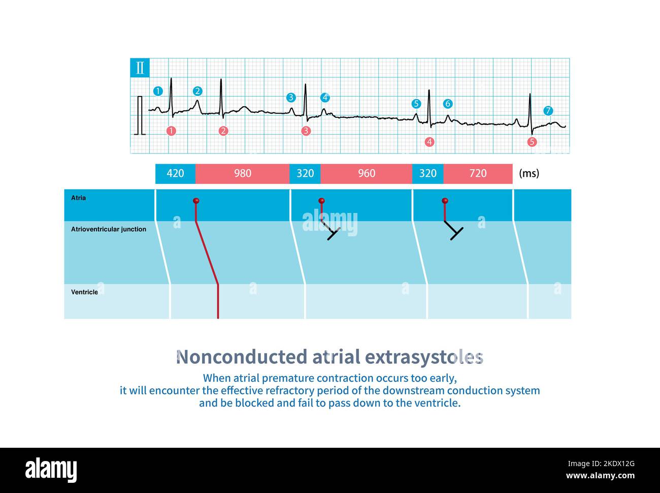 Nonconducted atrial extrasystoles, illustration Stock Photo - Alamy