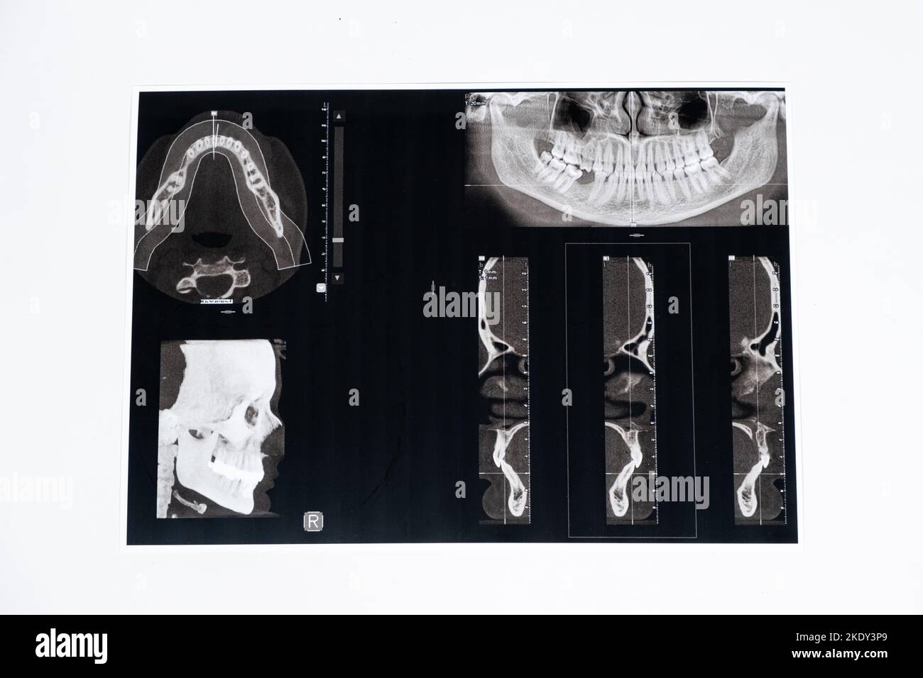 CT scan of a patient with malocclusion, missing chewing tooth and temporomandibular joint dysfunction. Stock Photo