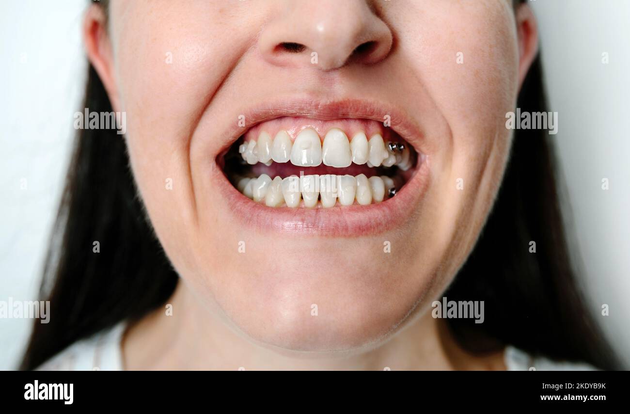 Woman with open mouth showing attachments and dental buttons for orthodontic treatment Stock Photo