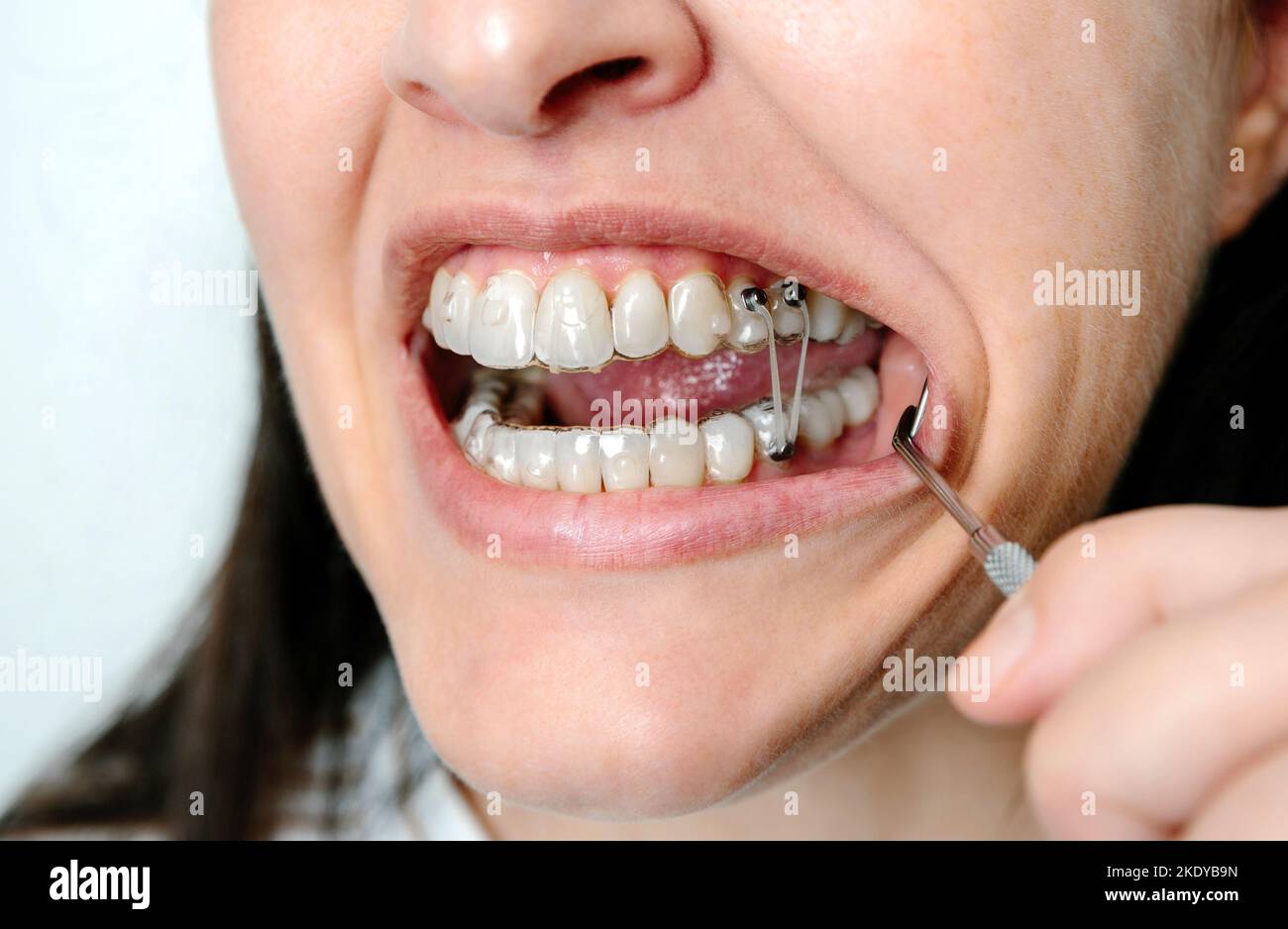 Woman with open mouth using dental buttons and elastic band for