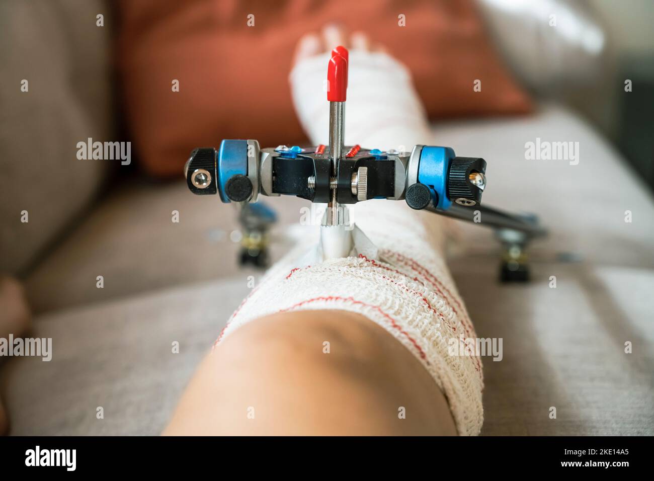 woman with External fixation right tibial fracture Stock Photo Alamy