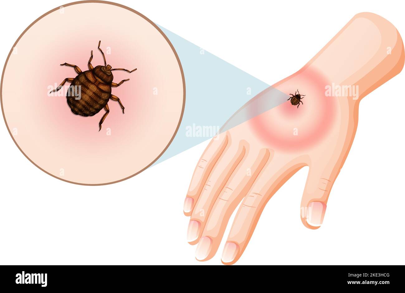 Bed bug bites sting on skin illustration Stock Vector Image & Art Alamy
