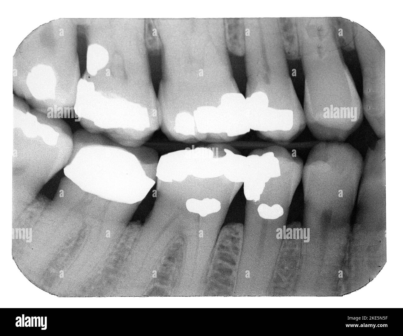Dental X-ray of teeth Stock Photo