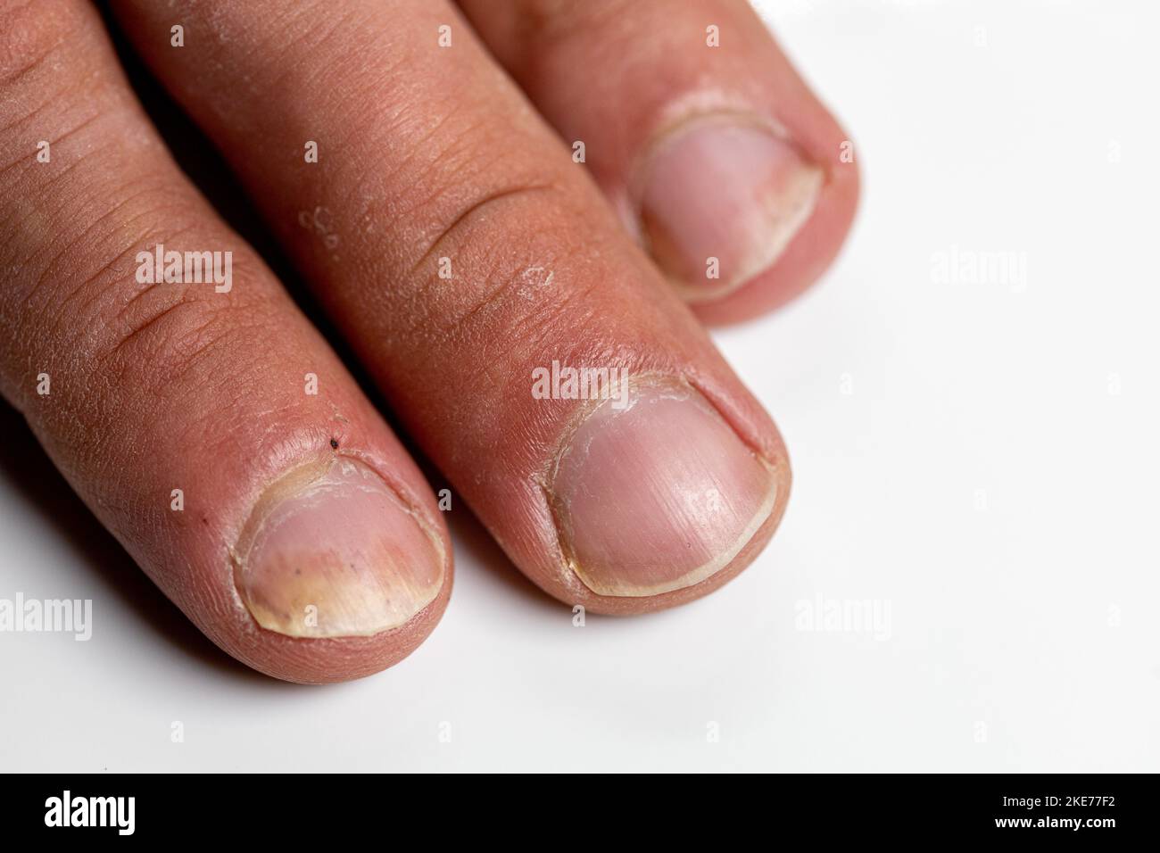 A closeup of the fingers of a patient with Psoriatic onychodystrophy or