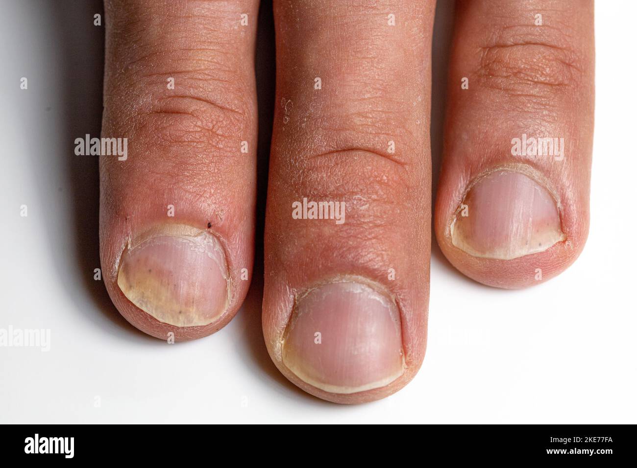 150+ Nail Psoriasis Stock Illustrations, Royalty-Free Vector Graphics &  Clip Art - iStock | Hand