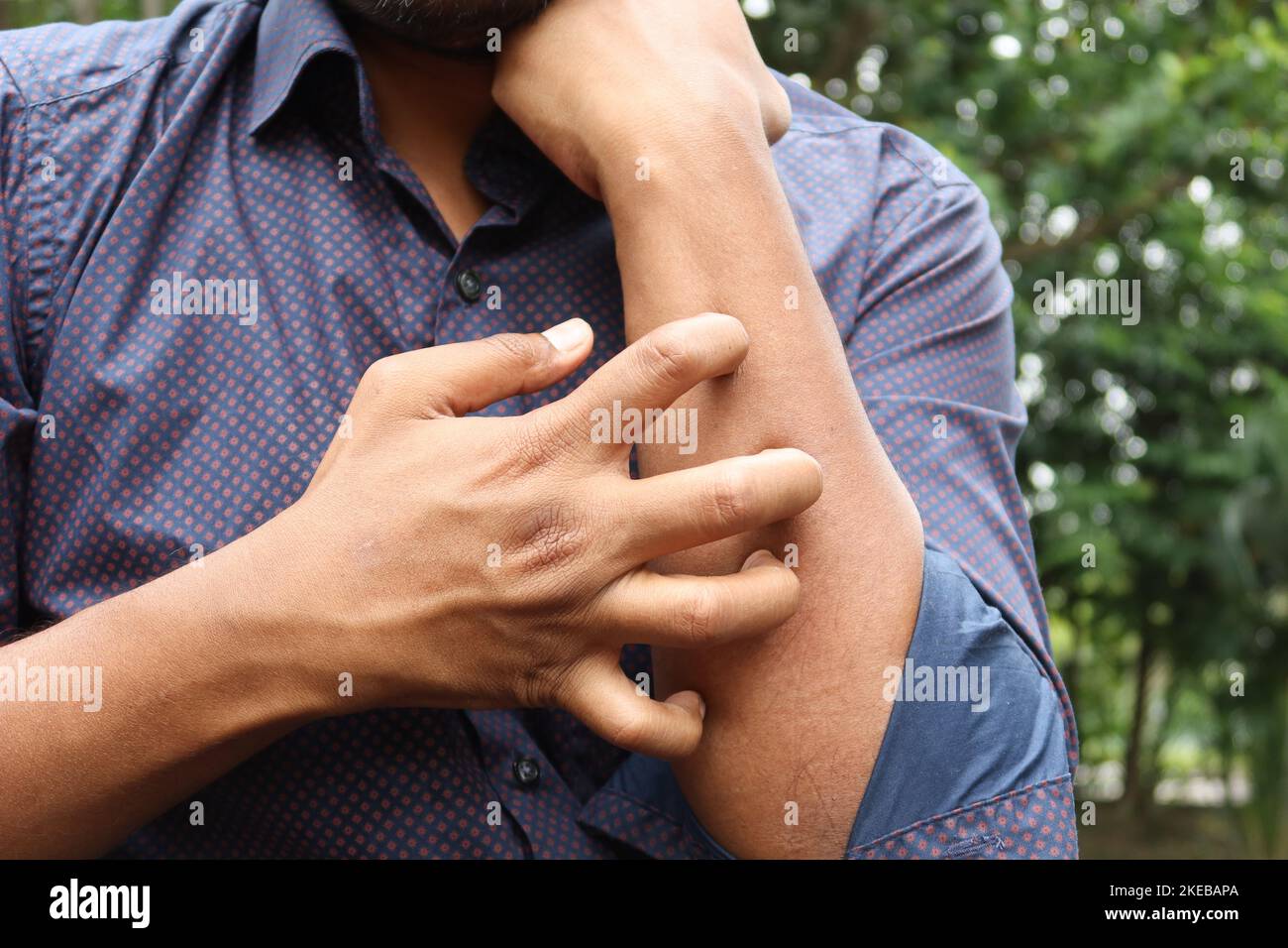 Man suffering from itching skin hi-res stock photography and images - Alamy