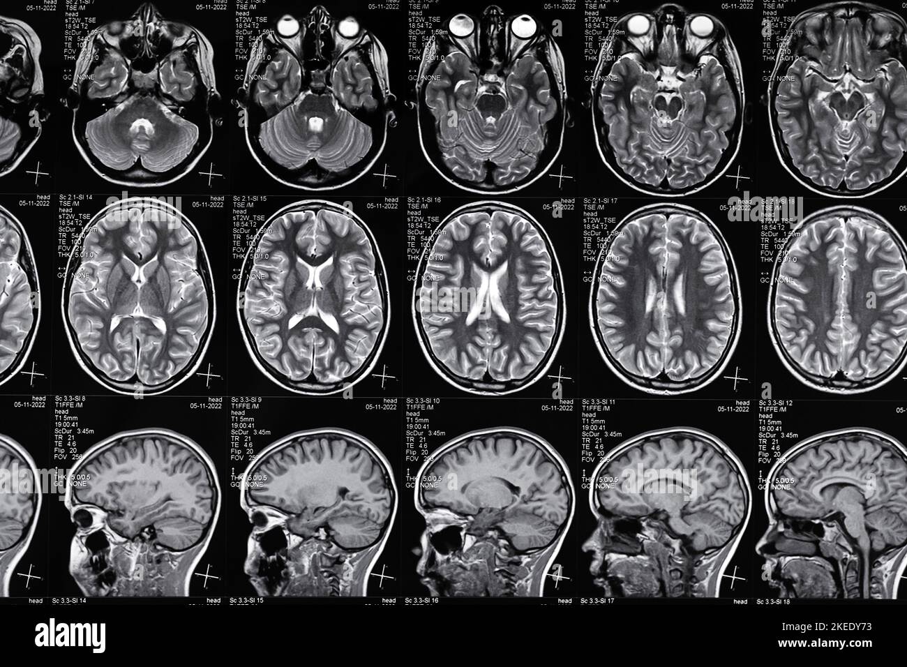 High resolution magnetic resonance image scan of brain epi syndrome. Real MRI scan of head, close up. Stock Photo
