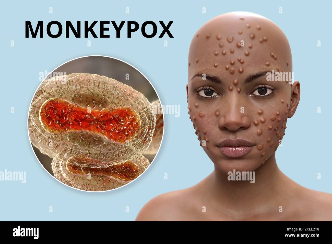 Monkeypox infection, illustration Stock Photo Alamy