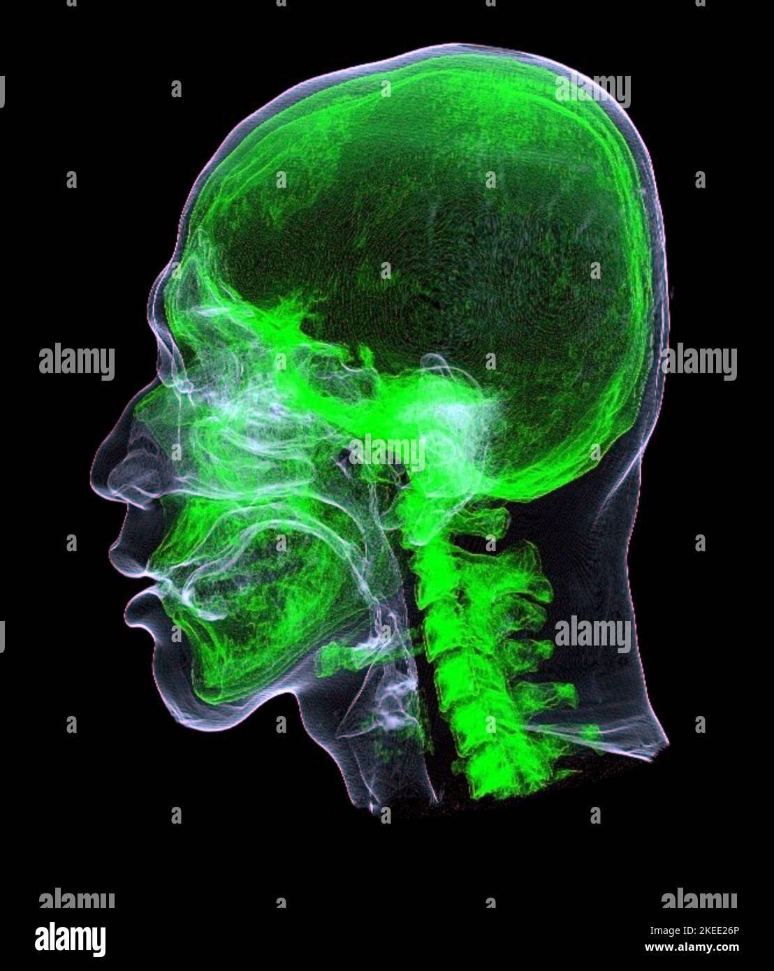 Head and neck, CT scan Stock Photo