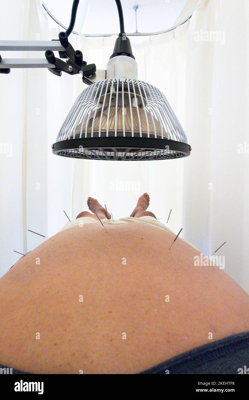 Asian man receiving acupuncture and heat treatment on belly Stock Photo