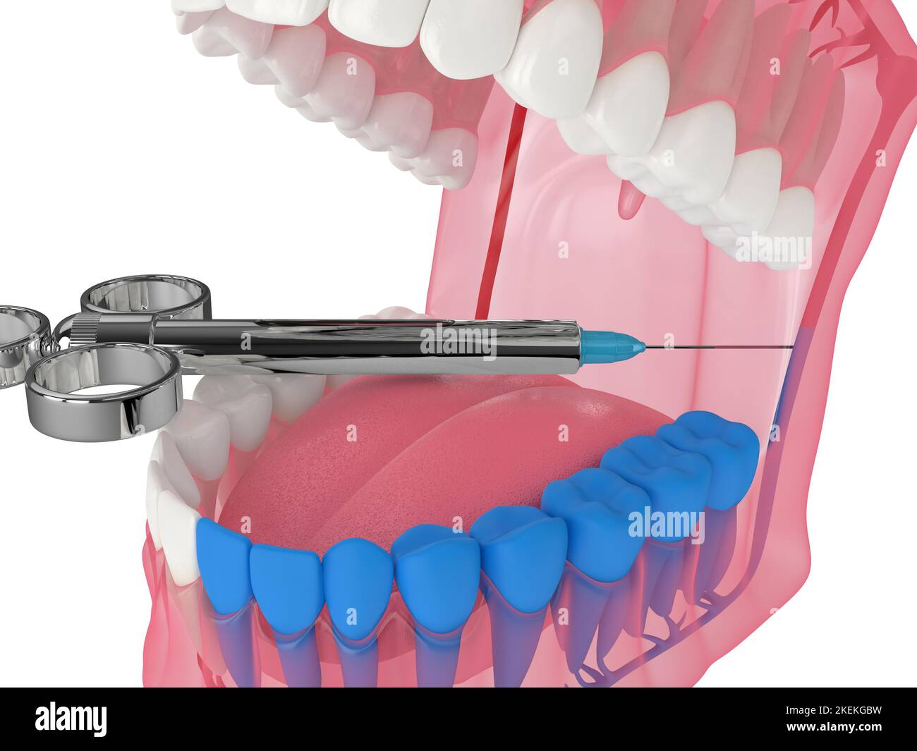 3d render of human jaw with inferior alveolar nerve block technique