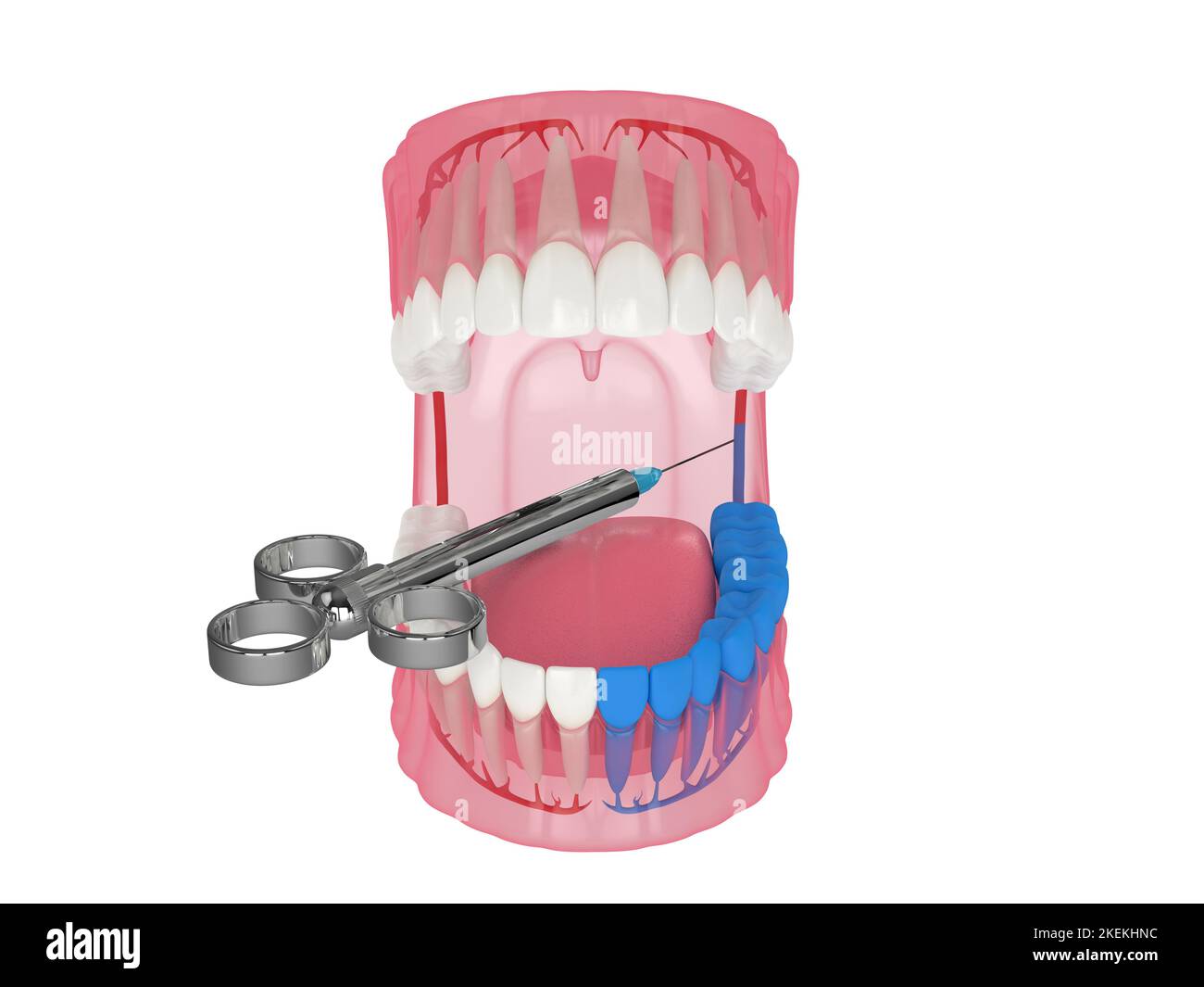 3d render of human jaw with inferior alveolar nerve block technique