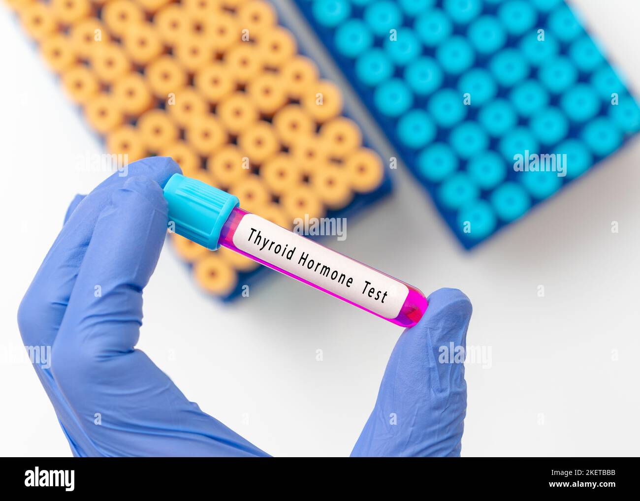 Thyroid hormone test result with blood sample in test tube on doctor