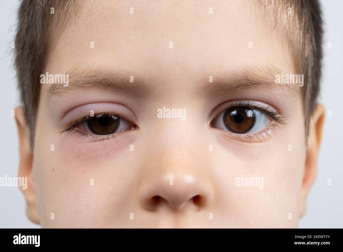 Eye of a child with conjunctivitis, inflammation of the conjunctiva, close-up. Stock Photo