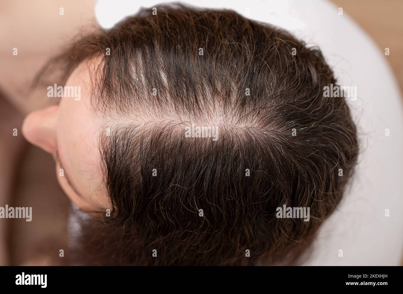 Top view of a woman with hair loss and no volume Stock Photo