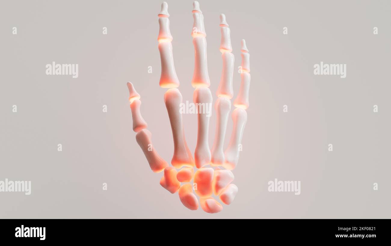 Rheumatoid arthritis on white background - 3D rendering Stock Photo