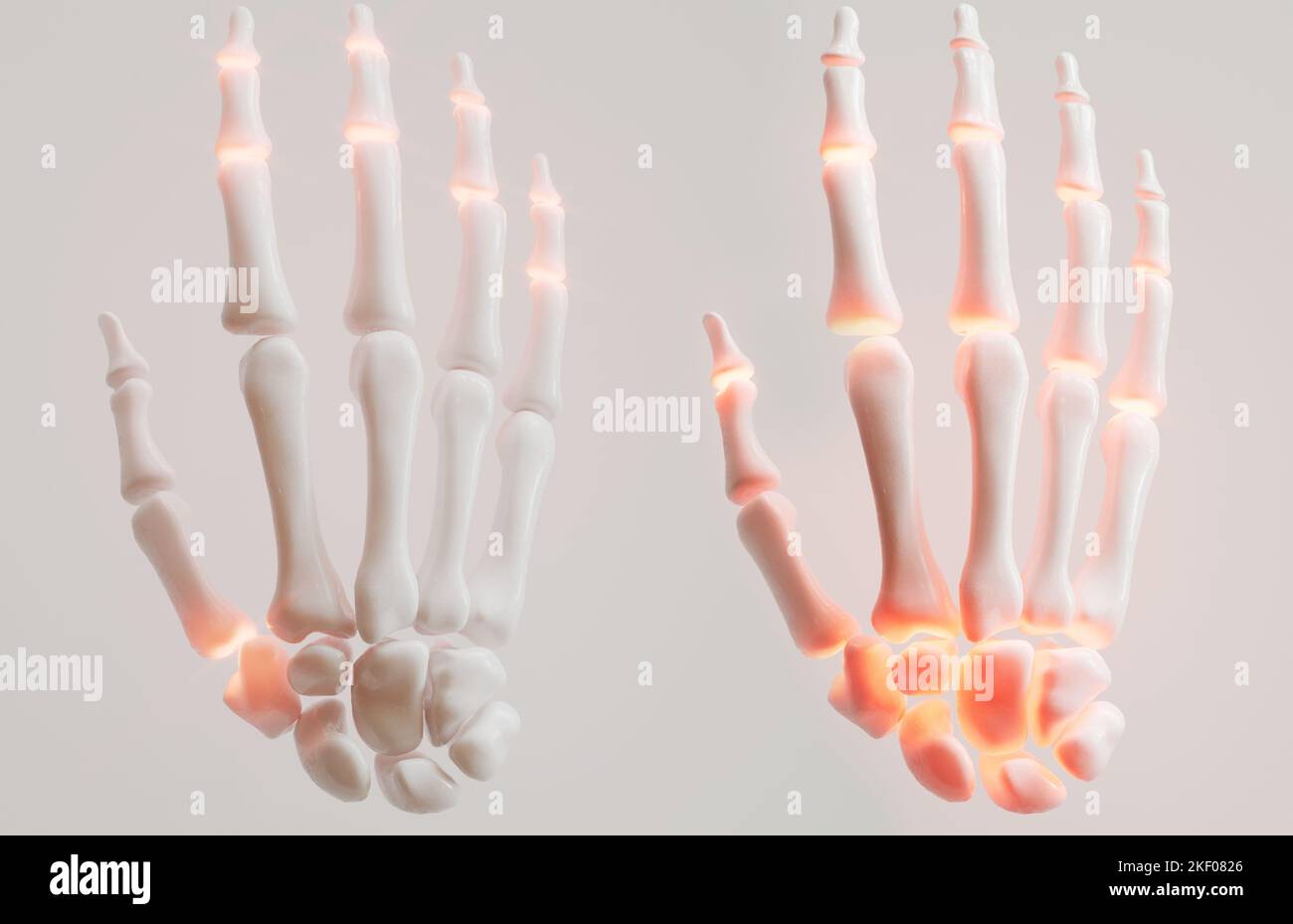 Rheumatoid arthritis and finger polyarthrosis in comparison - 3D rendering Stock Photo