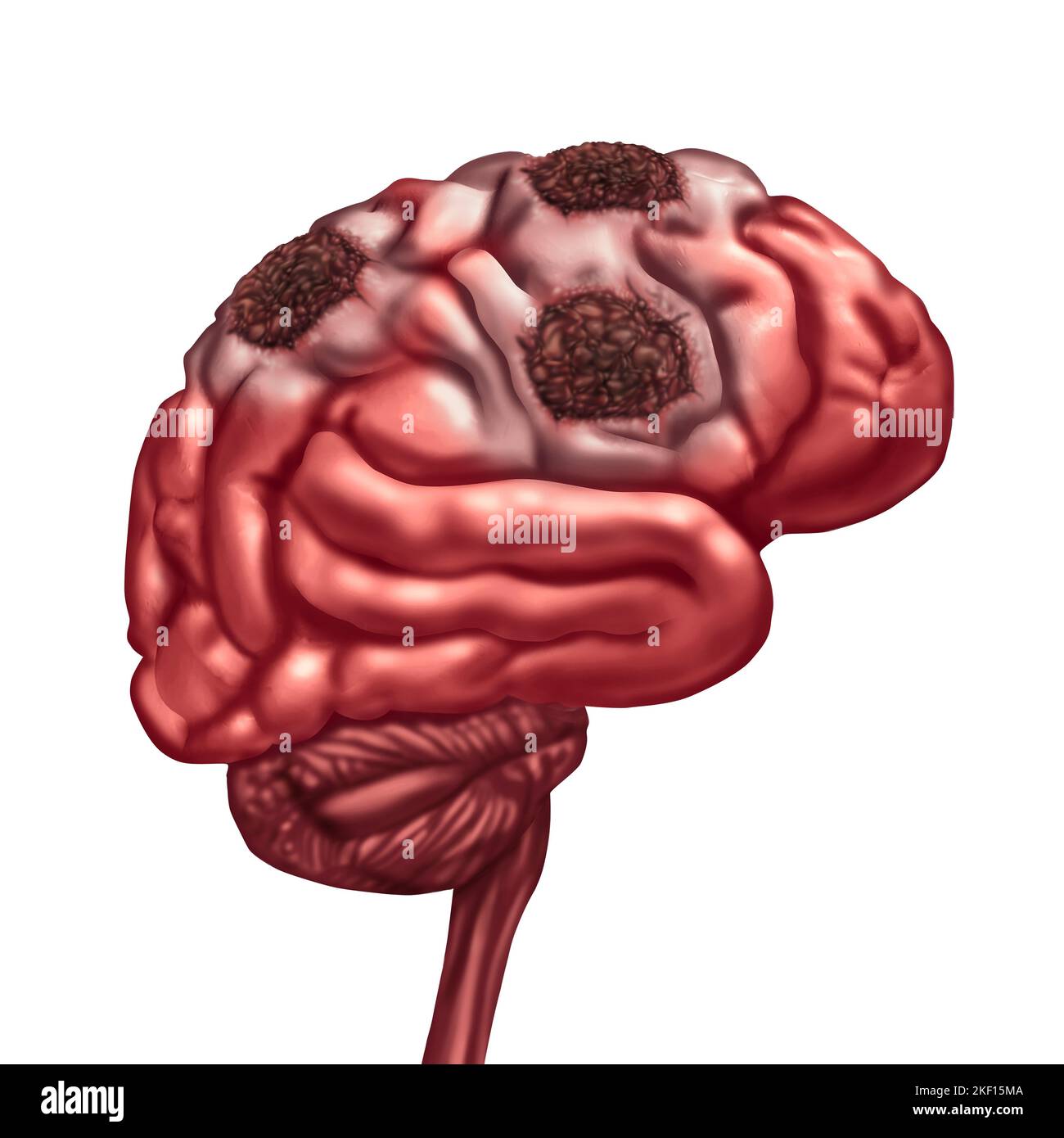 Brain Liquefactive Necrosis due to loss of blood circulation to the mind after a stroke caused by artery blockage resulting in dead tissue damage Stock Photo