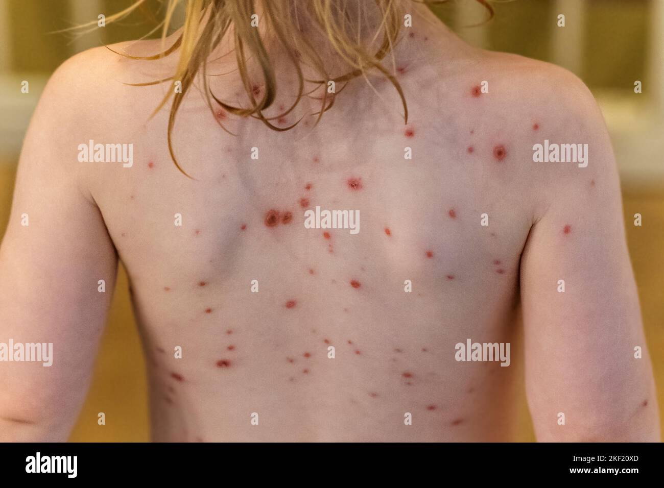 Small Chickenpox A portrait of the back of a small child with the chicken pox dissease ...