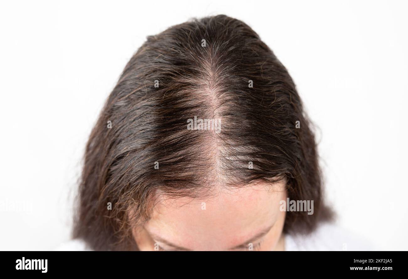 Hair loss concept. Head of woman on white background, closeup Stock Photo