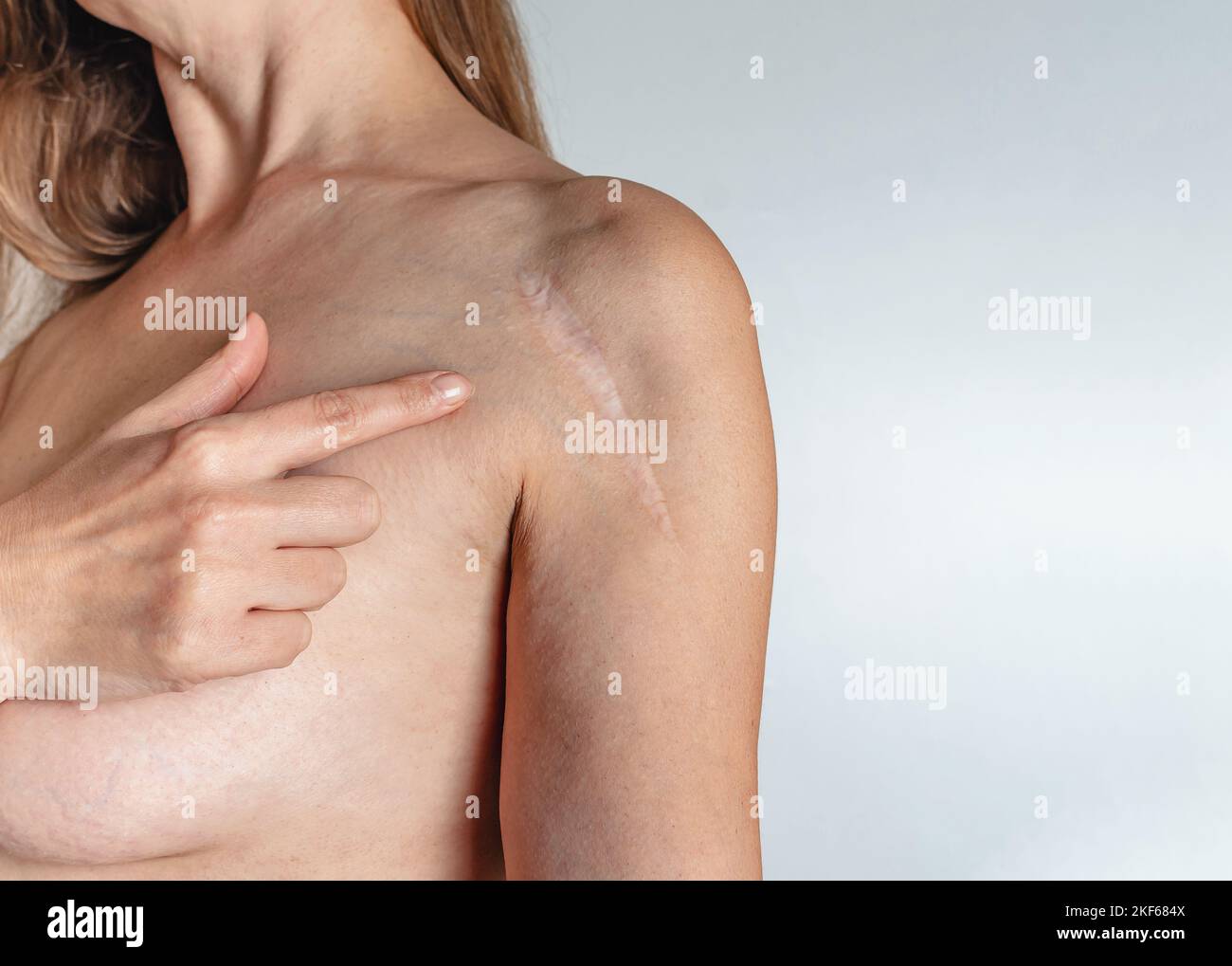 Woman have scar on shoulder over white background. Installation of a metal plate after fracture. Woman pointing finger at shoulder scar. Stock Photo
