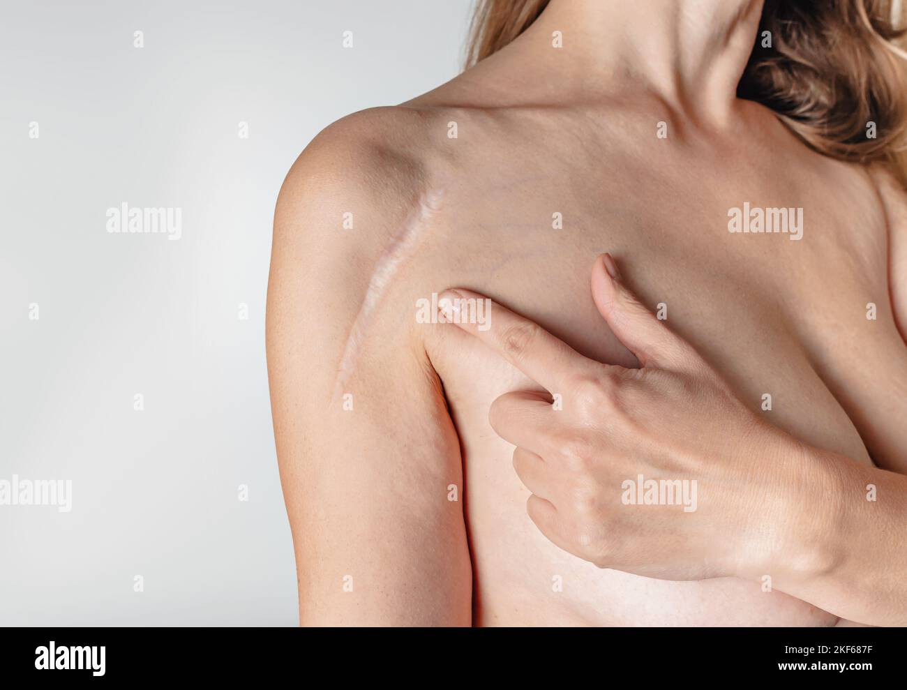 Woman have scar on shoulder over white background. Installation of a metal plate after fracture. Woman pointing finger at shoulder scar. Stock Photo