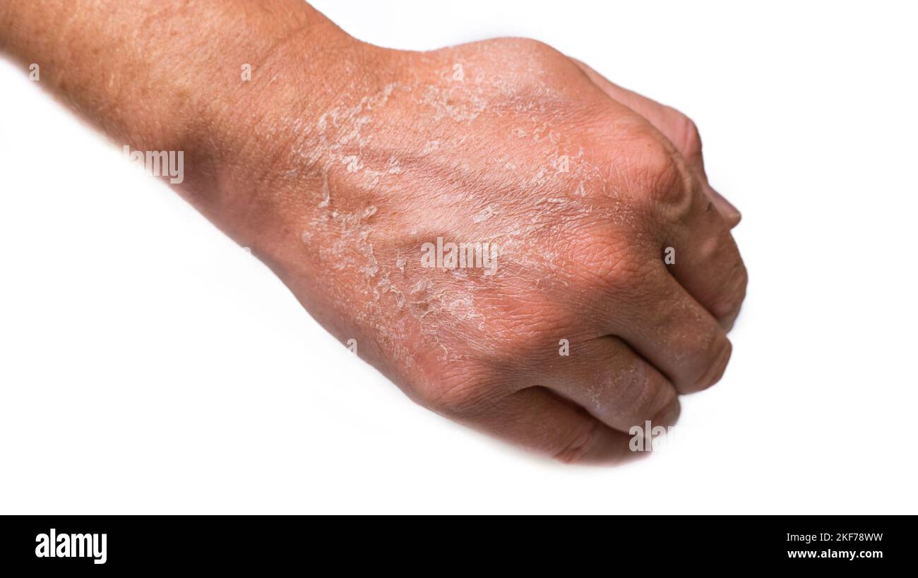 skin peels off the hand after a sunburn close-up isolate. Stock Photo