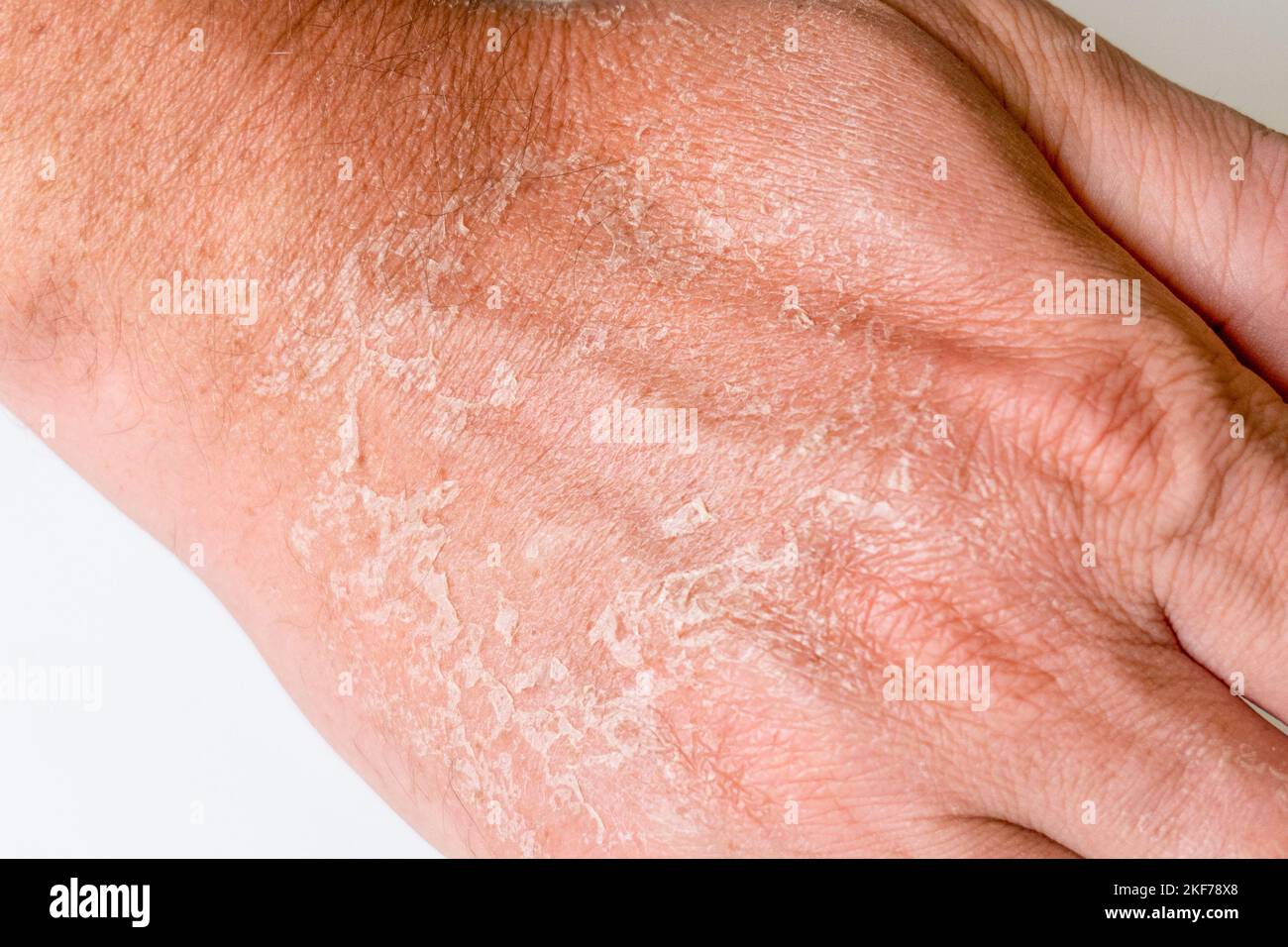 skin peels off the hand after a sunburn close-up isolate. Stock Photo