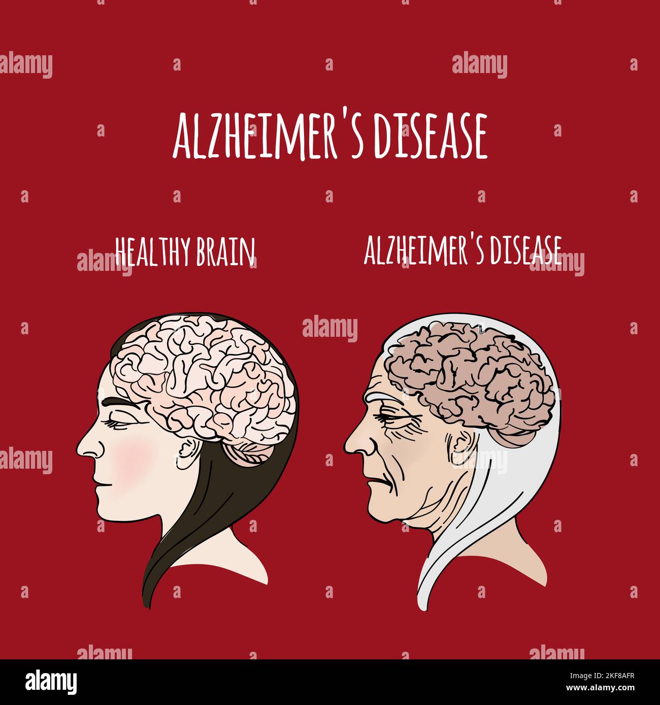 Treatment Of Alzheimer Dementia Hi Res Stock Photography And Images Alamy Treatment Of Alzheimer Dementia Hi Res Stock Photography And Images Alamy