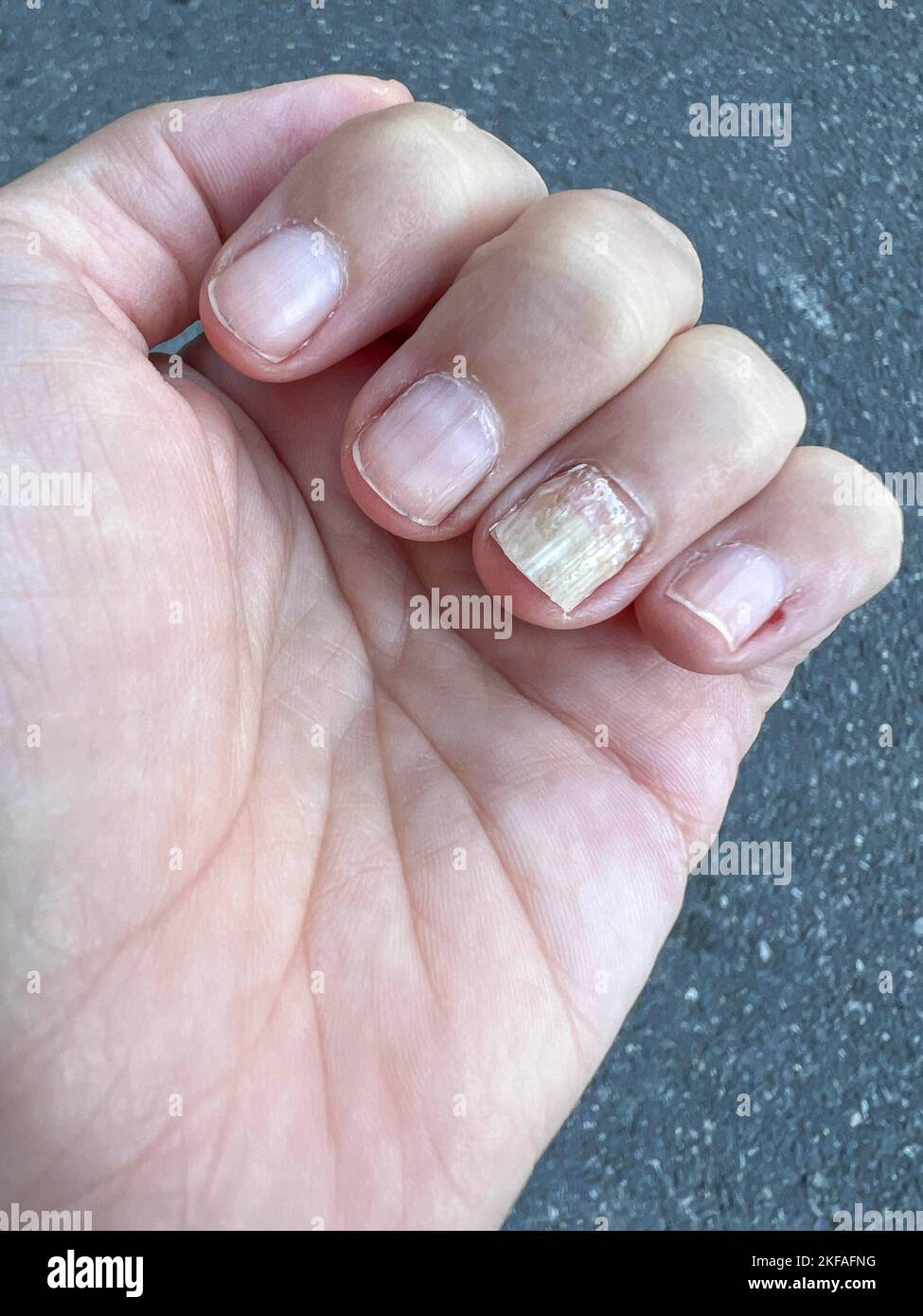 Fungus, Closeup nail fungus infection on hand finger of caucasian woman